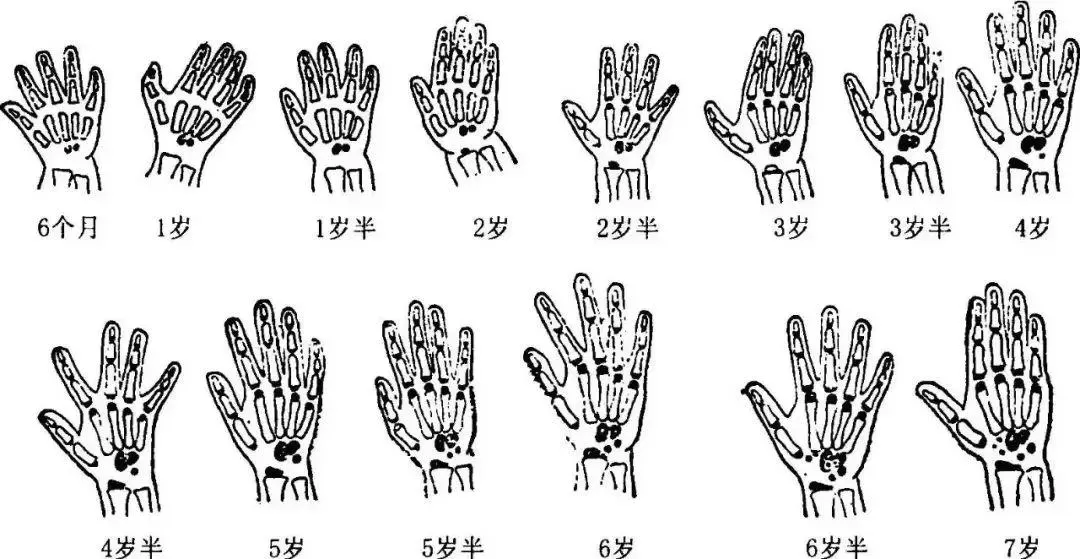 测骨龄准确率有多少？骨龄检测预测身高并不一定准确插图-1西米明天