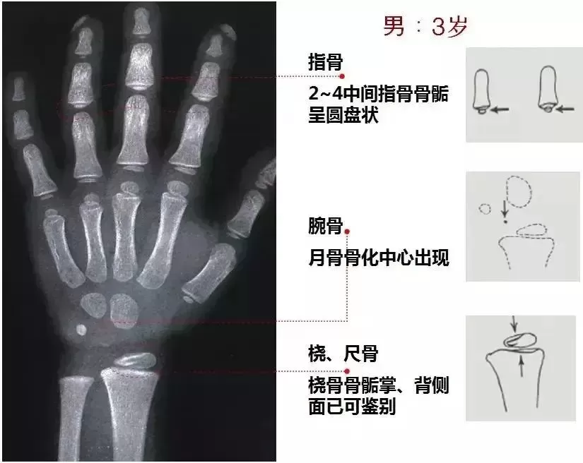 测骨龄准确率有多少？骨龄检测预测身高并不一定准确插图-西米明天